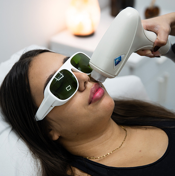 Tratamiento de depilación láser facial realizado en centro estético en Villena